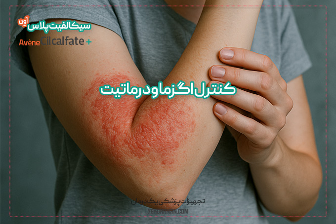 بهبود اگزما با سیکالفیت